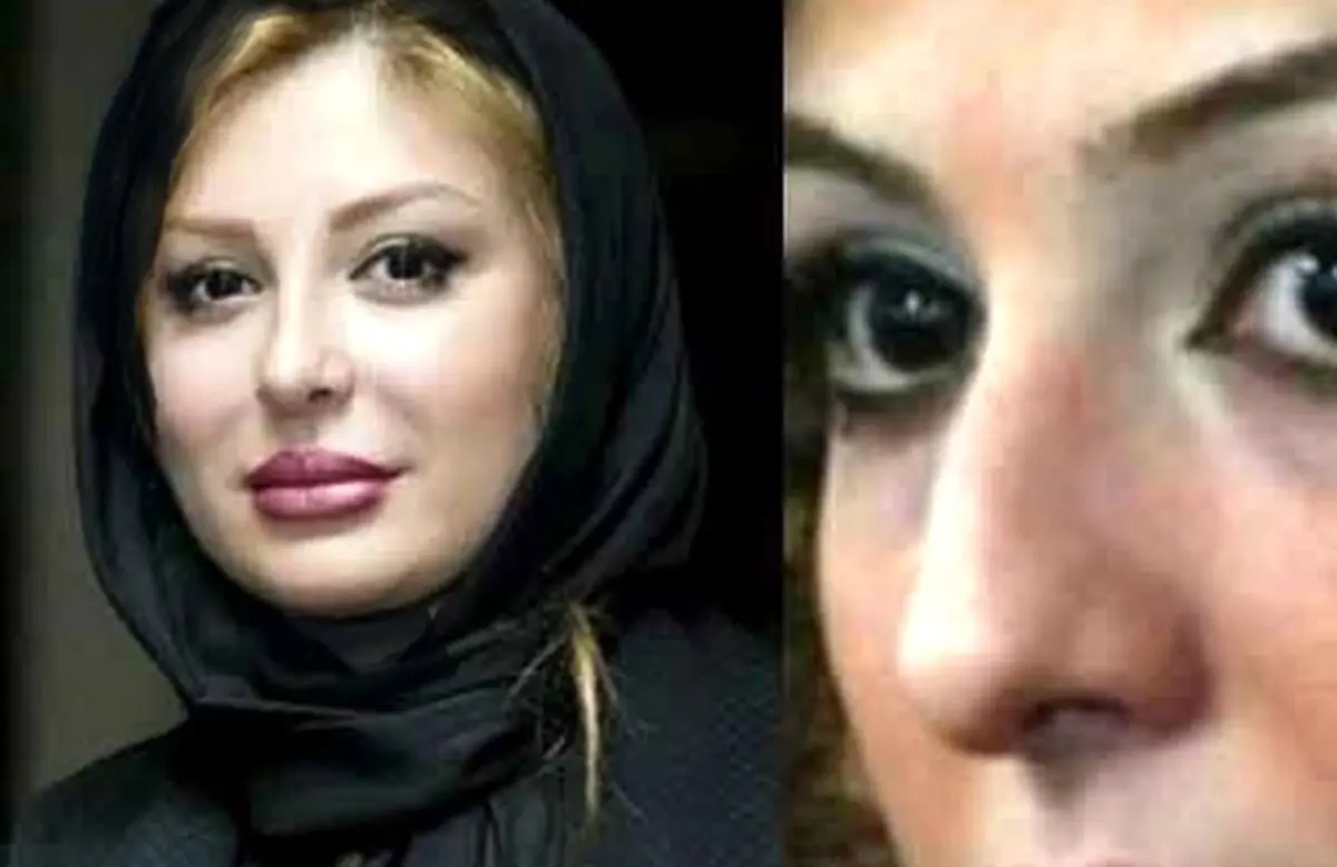 تصاویر قبل و بعد عمل زیبایی ستاره‌های ایرانی: تغییرات چشم‌گیر بازیگران زن و مرد در دنیای هنر