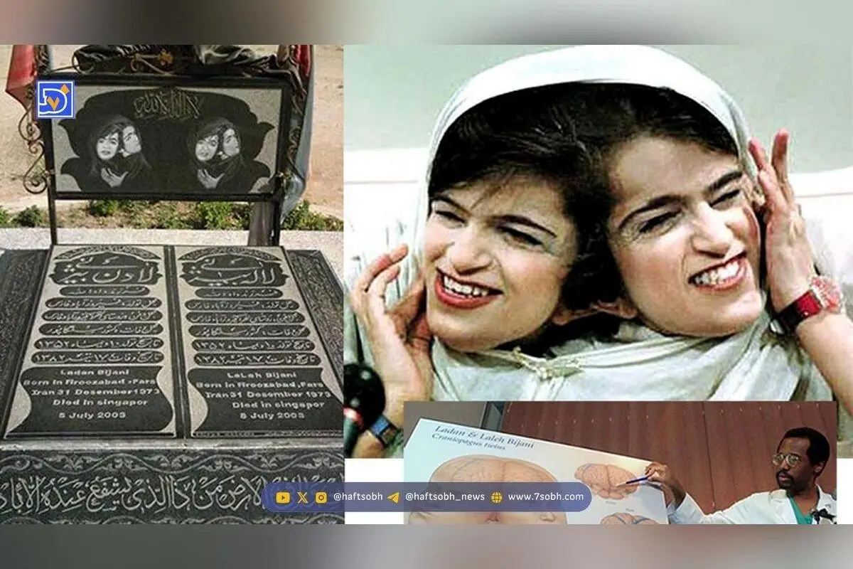 داستان غم‌انگیز دوقلوهای به‌هم چسبیده لاله و لادن بیژنی؛ سفر در زمان و تراژدی جداسازی