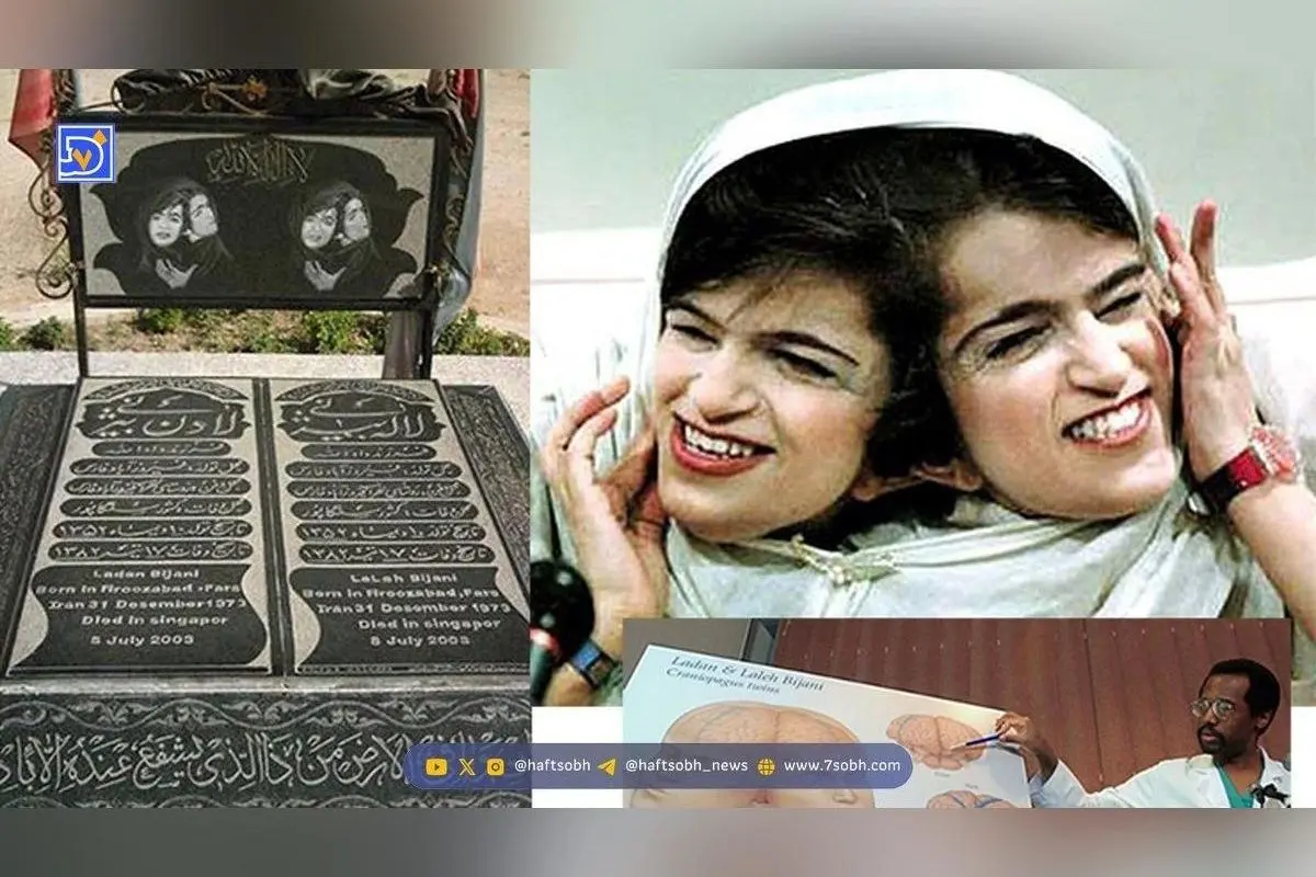 داستان غم‌انگیز دوقلوهای به‌هم چسبیده لاله و لادن بیژنی؛ سفر در زمان و تراژدی جداسازی