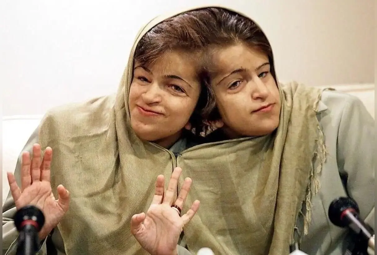 داستان غم‌انگیز و عبرت‌آموز لاله و لادن؛ دوقلوهای چسبیده‌ای که سرنوشتشان در دستان پزشکان رقم خورد
