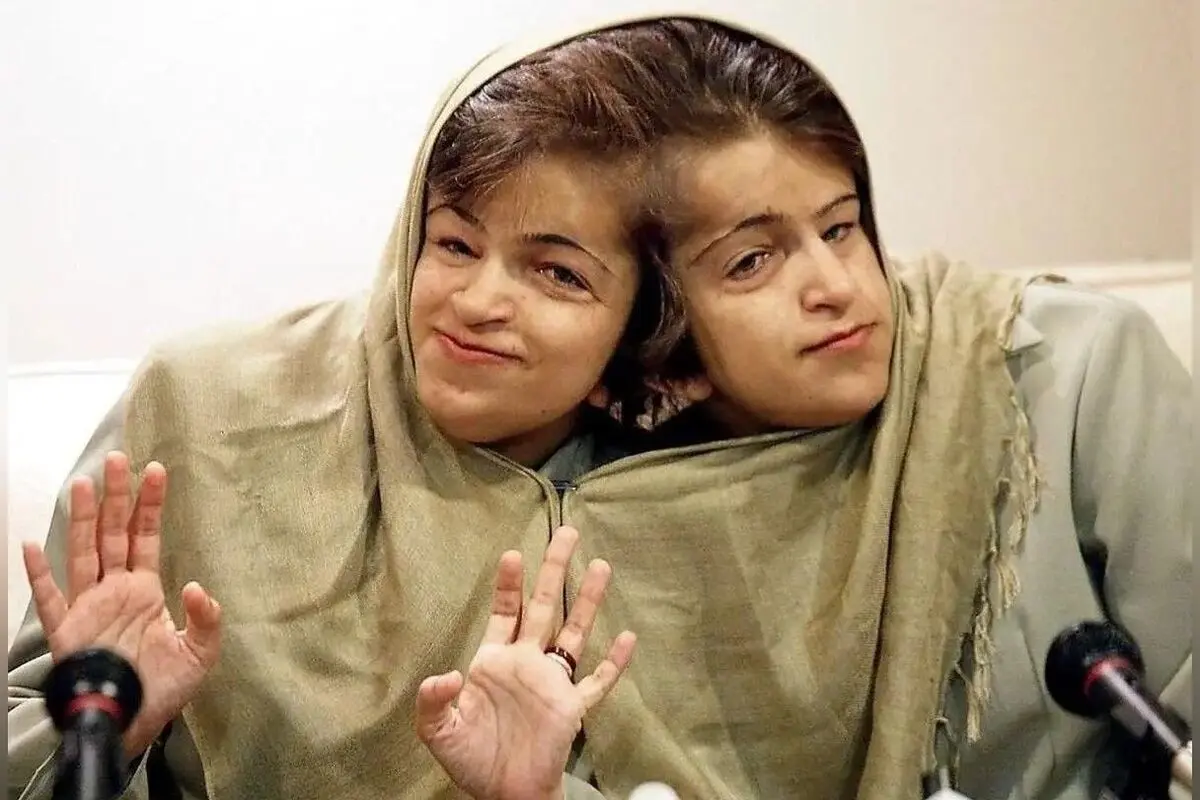 داستان غم‌انگیز و عبرت‌آموز لاله و لادن؛ دوقلوهای چسبیده‌ای که سرنوشتشان در دستان پزشکان رقم خورد