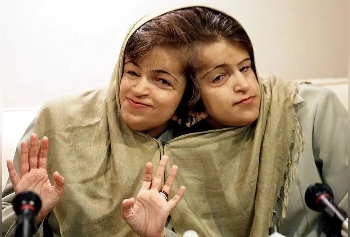 داستان غم‌انگیز و عبرت‌آموز لاله و لادن؛ دوقلوهای چسبیده‌ای که سرنوشتشان در دستان پزشکان رقم خورد